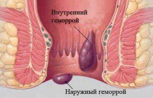 геморрой