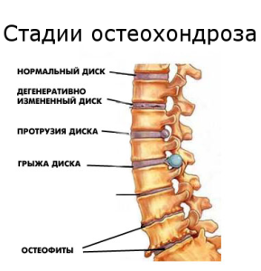 остеохондроз