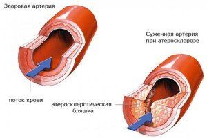 атеросклероз