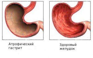 гастрит лечение