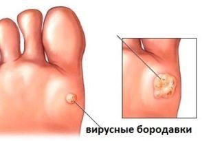 вирусные бородавки