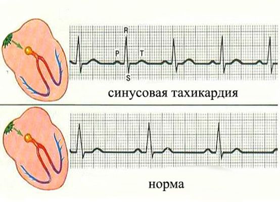 тахикардия сердца