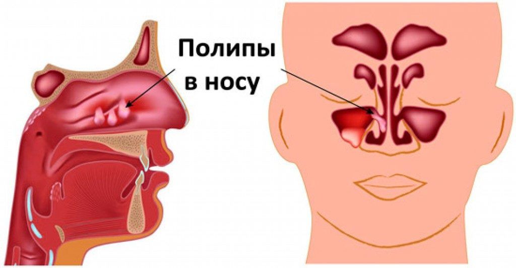 При отеке носа заложенности какими травами дышать thumbnail