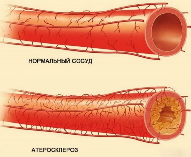 атеросклероз сосуды