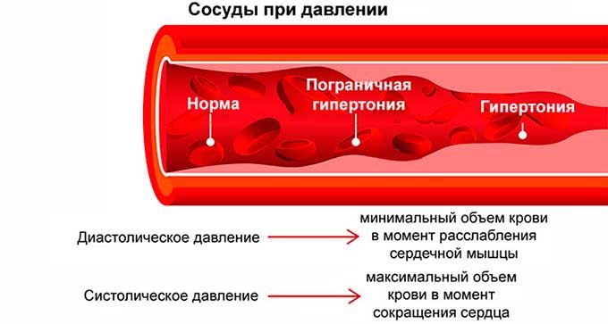 сосуды гипертония