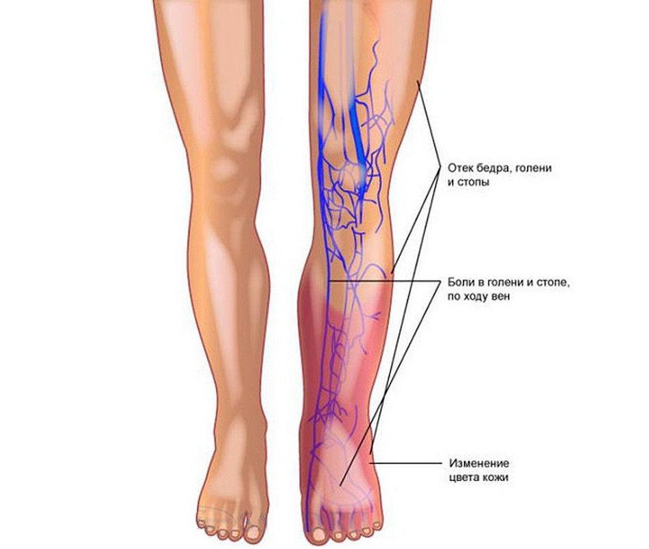 тромбофлебит