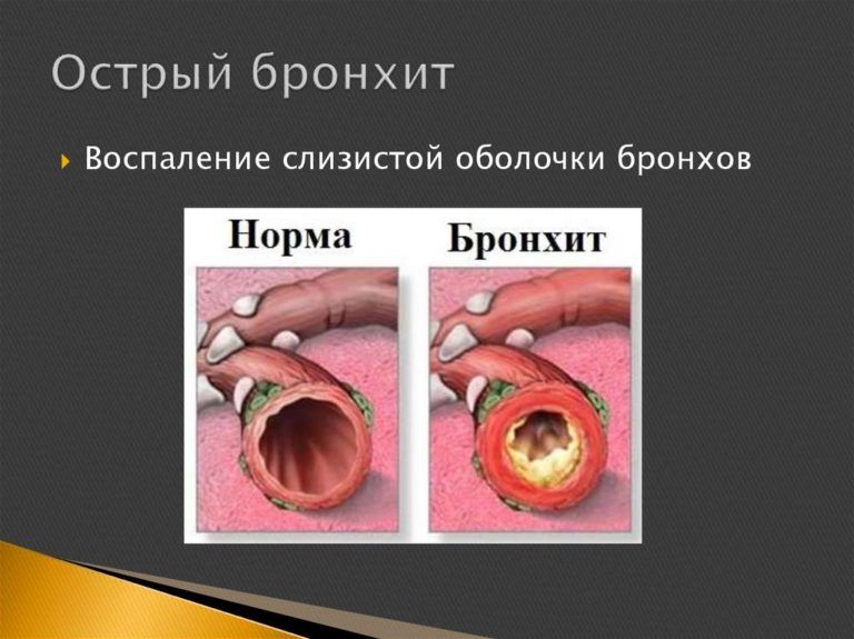 Бронхит - виды, симптомы, лечение в домашних условиях, причины